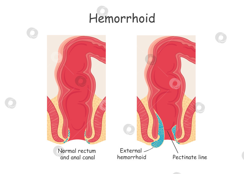 Скачать Геморрой в прямой кишке. Векторная иллюстрация в мультяшном стиле. фотосток Ozero