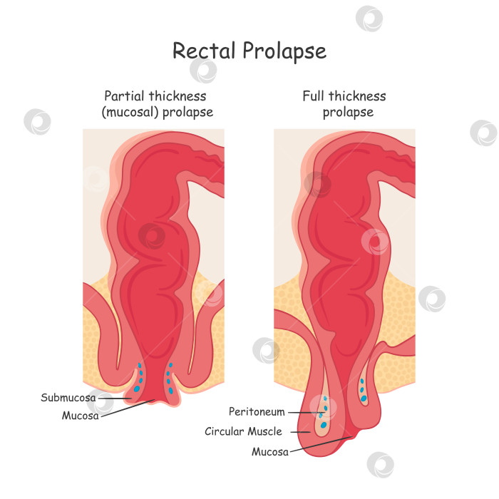 Скачать Выпадение прямой кишки. Два вида проктологических заболеваний. фотосток Ozero