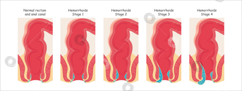 Скачать Геморрой в прямой кишке. Векторная иллюстрация в мультяшном стиле. фотосток Ozero