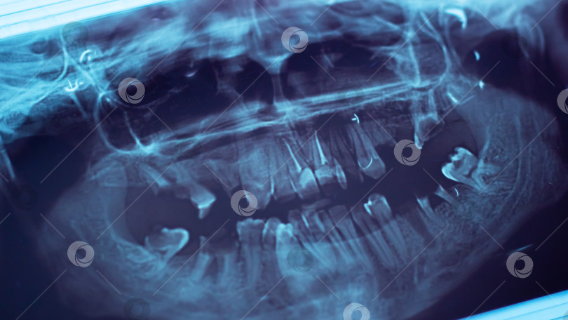 Скачать Это детальный рентгеновский снимок зубов человека крупным планом фотосток Ozero