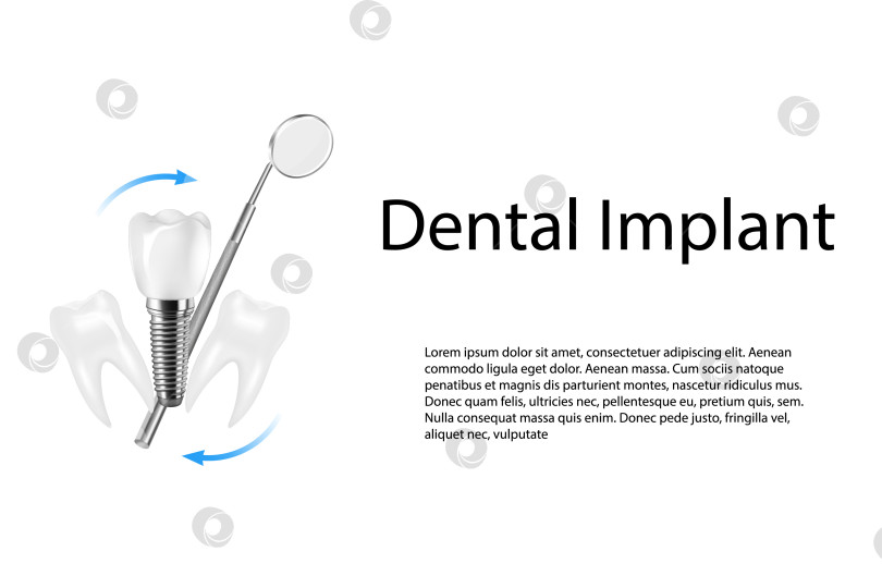 Скачать Реалистичная трехмерная композиция для дентальной имплантации. Иллюстрация стоматологической деятельности. фотосток Ozero