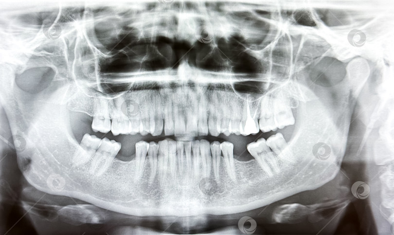 Скачать Рентгеновский снимок зубов, на котором подробно показано строение челюсти и зубов человека фотосток Ozero