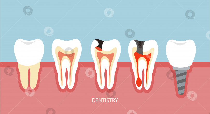Скачать Стоматология при стоматологических заболеваниях. Имплантация. Иллюстрация в плоском стиле. фотосток Ozero