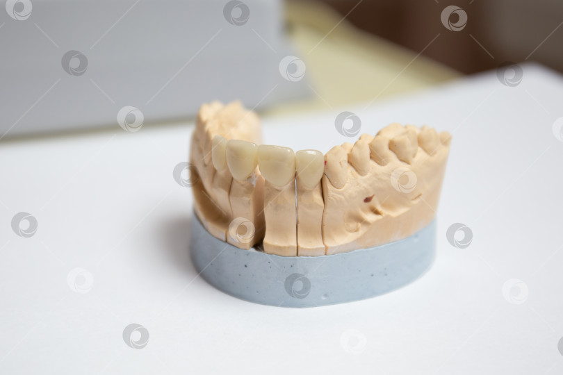 Скачать Гипсовая модель искусственной челюсти с винирами.Концепция эстетической стоматологии и дизайн виниров. Керамические виниры на коронки зубов. фотосток Ozero