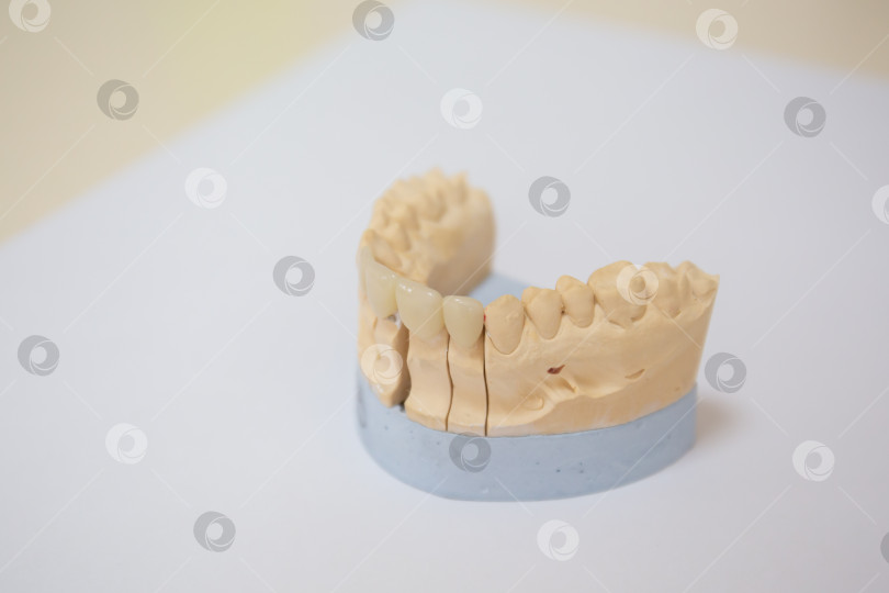 Скачать Гипсовая модель искусственной челюсти с винирами.Концепция эстетической стоматологии и дизайн виниров. Керамические виниры на коронки зубов. фотосток Ozero