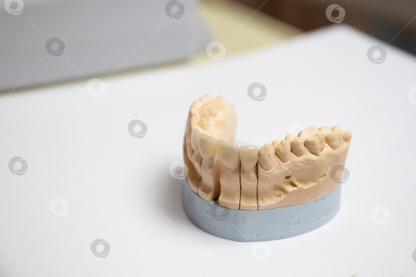 Скачать Гипсовая модель искусственной челюсти с винирами.Концепция эстетической стоматологии и дизайн виниров. Керамические виниры на коронки зубов. фотосток Ozero