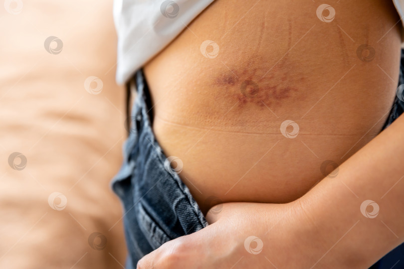 Скачать крупный план синяка на боку женского тела фотосток Ozero
