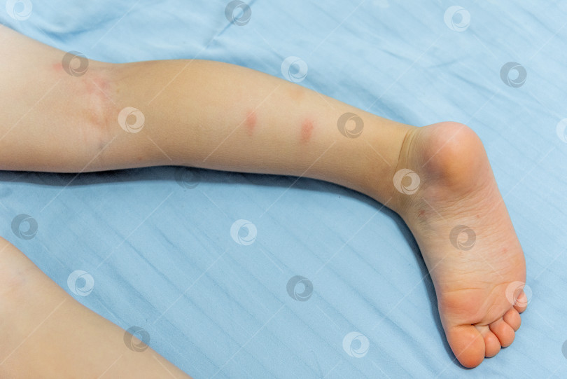 Скачать Детские ступни с укусами комаров крупным планом, кровососущие насекомые-паразиты укусили ребенка фотосток Ozero