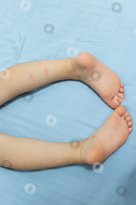 Скачать Детские ступни с укусами комаров крупным планом, кровососущие насекомые-паразиты укусили ребенка фотосток Ozero