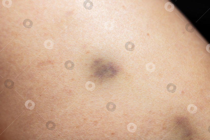 Скачать Крупный план синяков на светлой коже - заживающее изменение цвета фотосток Ozero