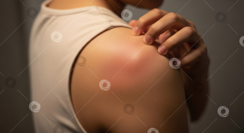 Скачать Девушка чешет раздраженную кожу на плече. Шаблон баннера с изображением осложнения диабета фотосток Ozero