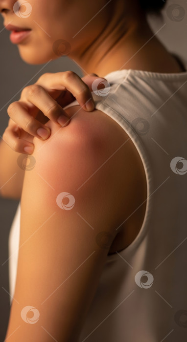 Скачать Девушка чешет раздраженную кожу на своем плече. фотосток Ozero