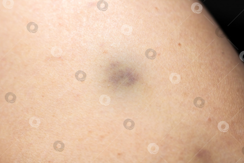 Скачать Изображение с высоким разрешением, демонстрирующее характеристики повреждений на бледной коже с акцентом на клиническом освещении фотосток Ozero