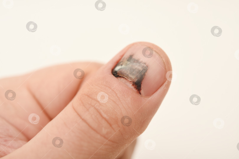 Скачать Поврежденный палец на руке. Поврежденный ноготь и кровь под ногтем. Регенерация ногтя. фотосток Ozero