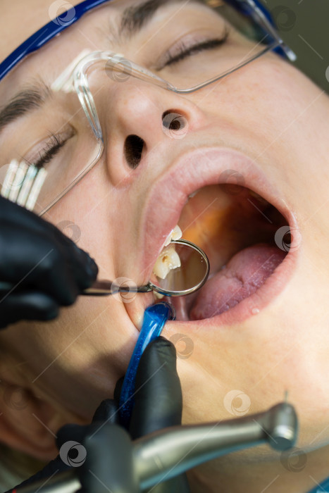 Скачать Лечение кариеса жевательного бокового зуба верхней челюсти фотосток Ozero