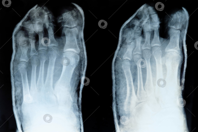 Скачать рентгеновский снимок пальцев ног со смещенным мизинцем фотосток Ozero