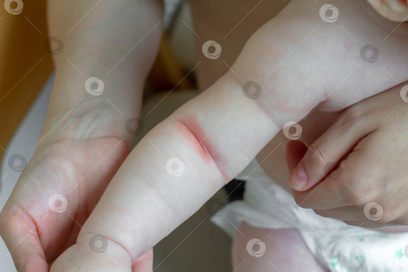 Скачать Колючий жар. Крупный план сгибов руки новорожденного ребенка с красной кожей. фотосток Ozero