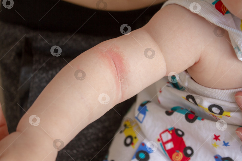 Скачать Колючий жар. Крупный план сгибов руки новорожденного ребенка с красной кожей. фотосток Ozero