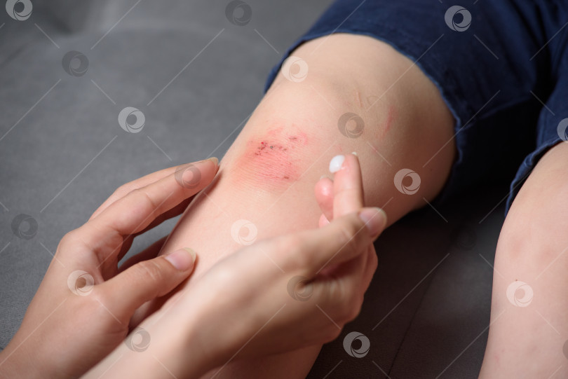 Скачать Лечение раненных детских коленей. Нанесение антибактериального крема фотосток Ozero