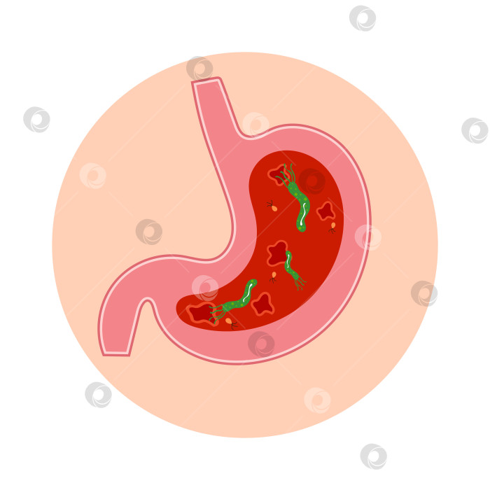 Скачать Желудок с Helicobacter pylori, язвами и бактериями внутри. фотосток Ozero