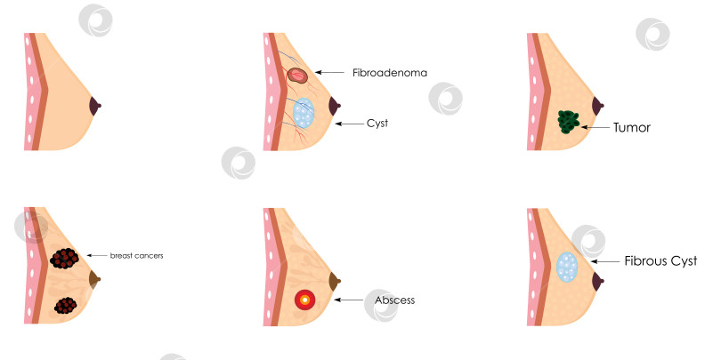 Скачать Коллекция иллюстраций реалистичных молочных желез. Кисты, рак, абсцесс, воспаление, фиброаденома, боль. фотосток Ozero