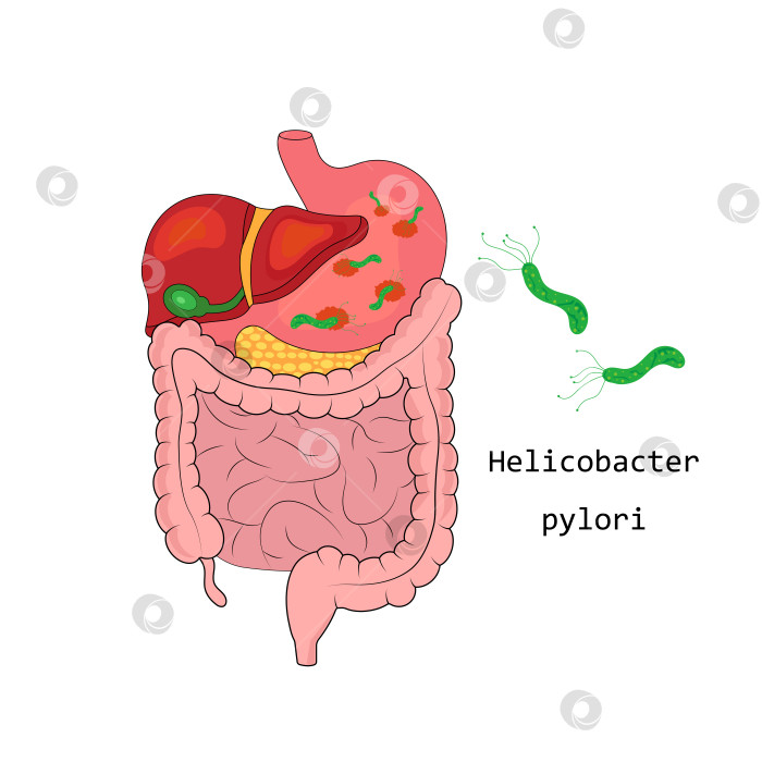 Скачать Желудок, пораженный Helicobacter pylori. Анатомия человека. фотосток Ozero