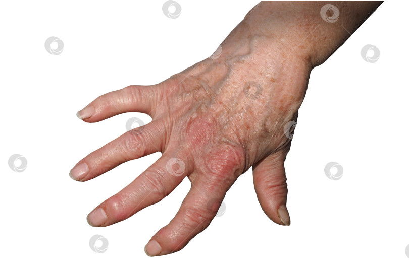 Скачать Рука Пожилой Женщины, Деформированная Ревматоидным Артритом фотосток Ozero