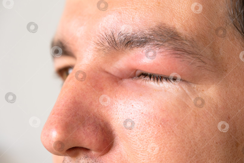 Скачать Красное опухшее веко на лице мужчины крупным планом - это аллергия. фотосток Ozero
