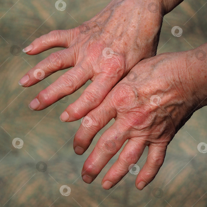 Скачать Руки пожилой дамы, страдающей тяжелым ревматоидным артритом фотосток Ozero