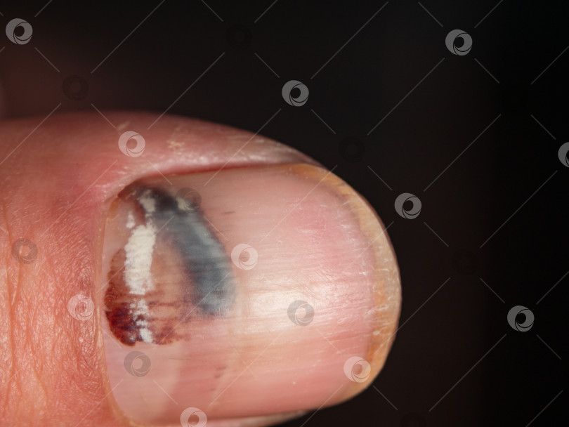 Скачать Крупный план пальца с гематомой под ногтем в результате  фотосток Ozero