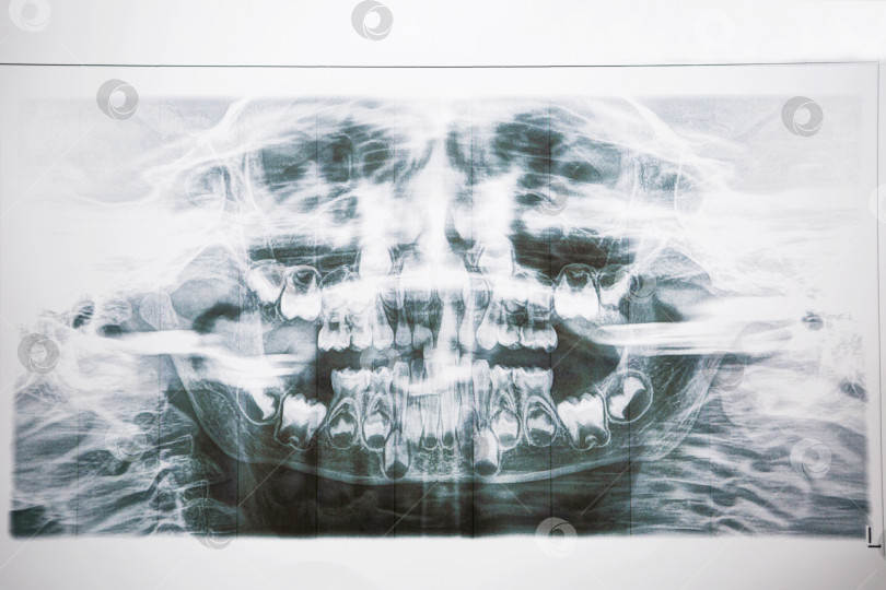 Скачать Рентгеновский снимок молочных желез и коренных зубов ребенка. Два ряда зубов, замените на постоянные. Здравоохранение и детская стоматология. фотосток Ozero