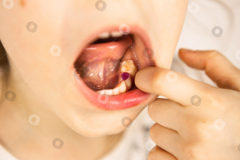 Скачать Окрашенная в фиолетовый цвет пломба на молочном жевательном зубе девочки. Детская стоматология, лечение и обследование. Ребенок с открытым ртом показывает зуб крупным планом на белом фоне. фотосток Ozero