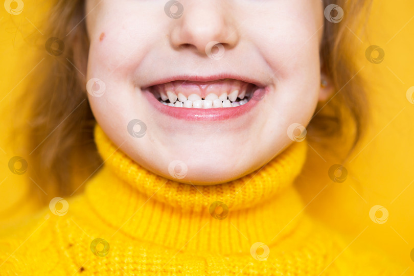 Скачать Девушка показывает свои зубы - патологический прикус, неправильный прикус, неправильный прикус. Детская стоматология и пародонтология, коррекция прикуса. Здоровье и уход за зубами, лечение кариеса, молочные зубы. Верхняя челюсть опирается на десну. фотосток Ozero