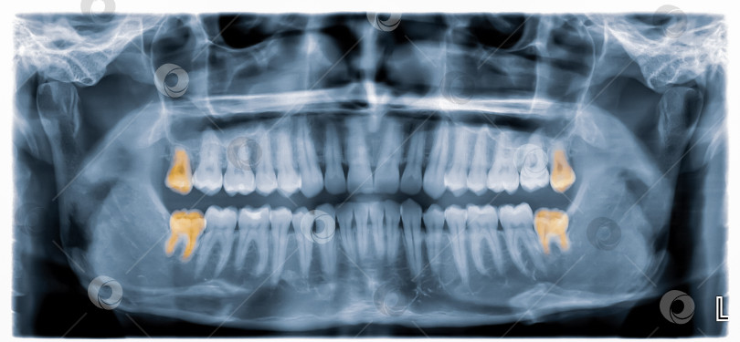 Скачать Рентген снимок челюсти человека фотосток Ozero
