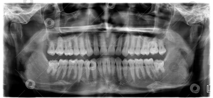 Скачать Рентген снимок челюсти человека фотосток Ozero