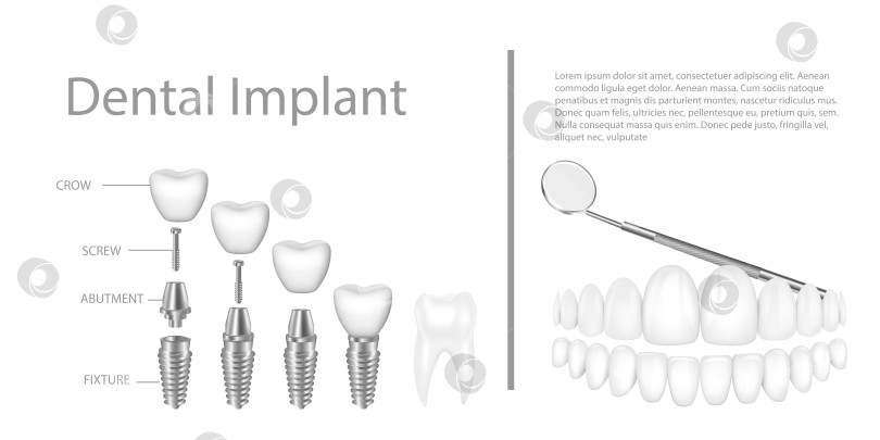 Скачать Структура зубного имплантата медицинский иллюстративный образовательный инфографический плакат с векторной иллюстрацией моделей здоровых инструментов для замены коренных зубов. фотосток Ozero