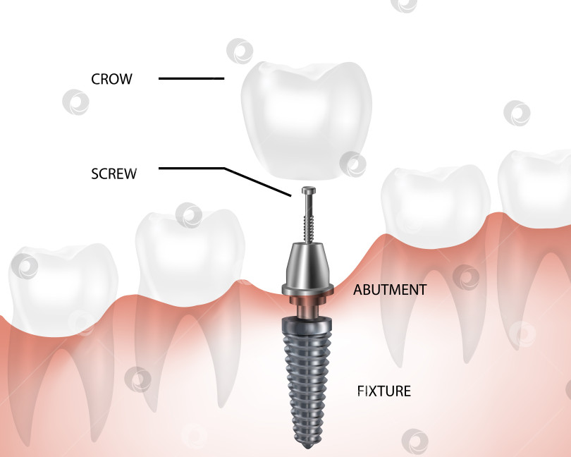 Скачать Составные части зубных имплантатов, компоненты зубных протезов, вектор. фотосток Ozero