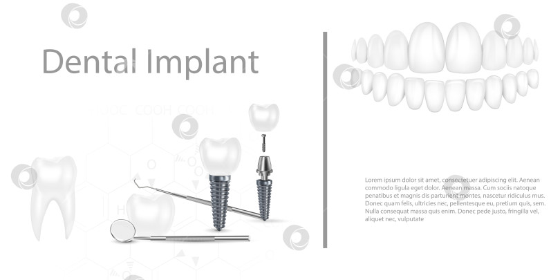 Скачать Структура зубного имплантата медицинский иллюстративный образовательный инфографический плакат с векторной иллюстрацией моделей здоровых инструментов для замены коренных зубов. фотосток Ozero