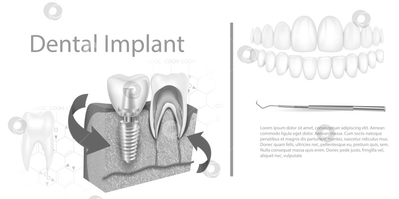 Скачать Структура зубного имплантата медицинский иллюстративный образовательный инфографический плакат с векторной иллюстрацией моделей здоровых инструментов для замены коренных зубов. фотосток Ozero