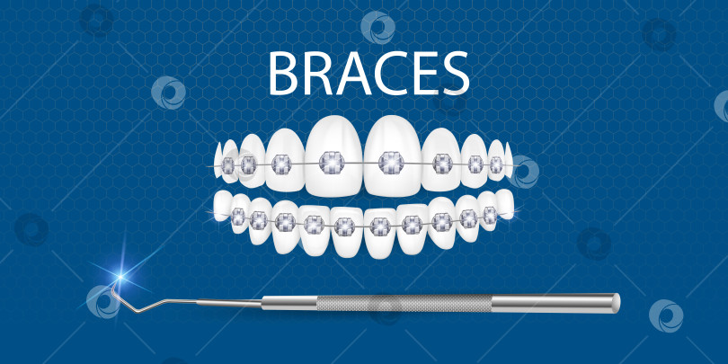 Скачать 3d векторная иллюстрация, реалистичные зубы с брекетами. Выравнивание прикуса зубов, формирование зубного ряда с помощью брекетов, зубных брекет-систем. фотосток Ozero
