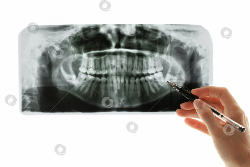 Скачать Крупный план панорамного сканирования зубов. Рука рентгенолога указывает на проблемную область на рентгеновском снимке фотосток Ozero