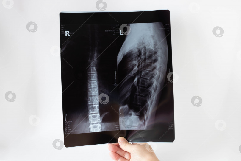 Скачать Медицинский рентген спины подростка.Концепция медицинского обслуживания фотосток Ozero