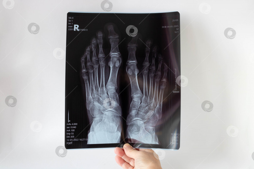 Скачать Рентгенография стопы в передней проекции. Медицинский рентген ног подростка.Концепция медицинского обслуживания фотосток Ozero