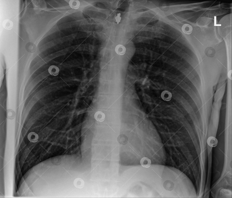 Скачать Рентгеновский снимок грудной клетки человека с легкими, грудным отделом позвоночника и грудной клеткой фотосток Ozero