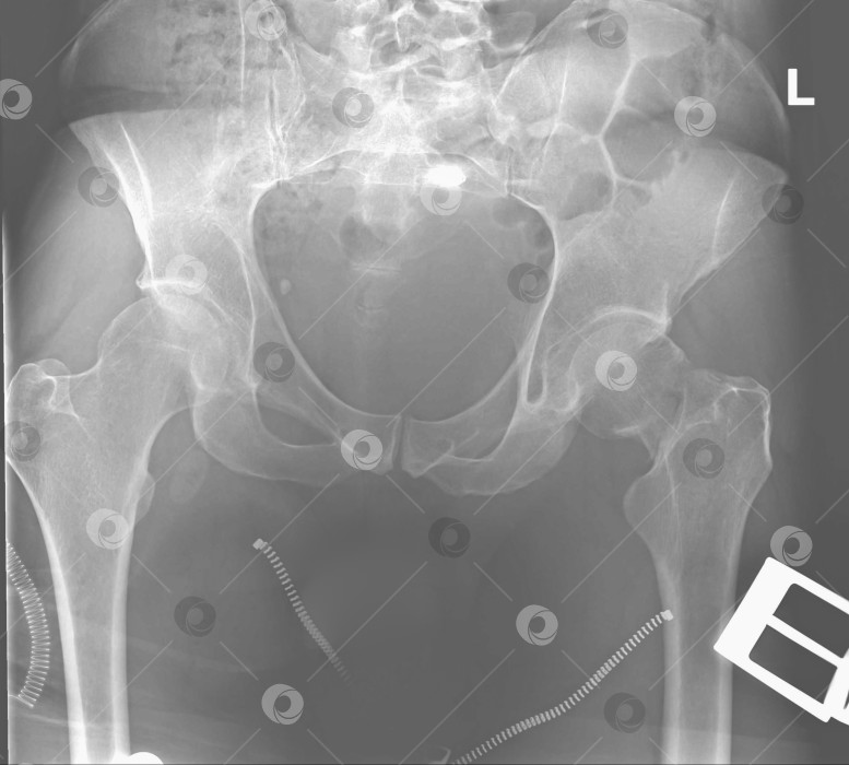 Скачать Рентгенограмма. День перелома. Перелом шейки левой бедренной кости фотосток Ozero