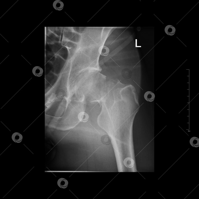Скачать Перелом левой трансцервикальной шейки. Перелом шейки бедренной кости. Рентгеновское фото мужчины фотосток Ozero