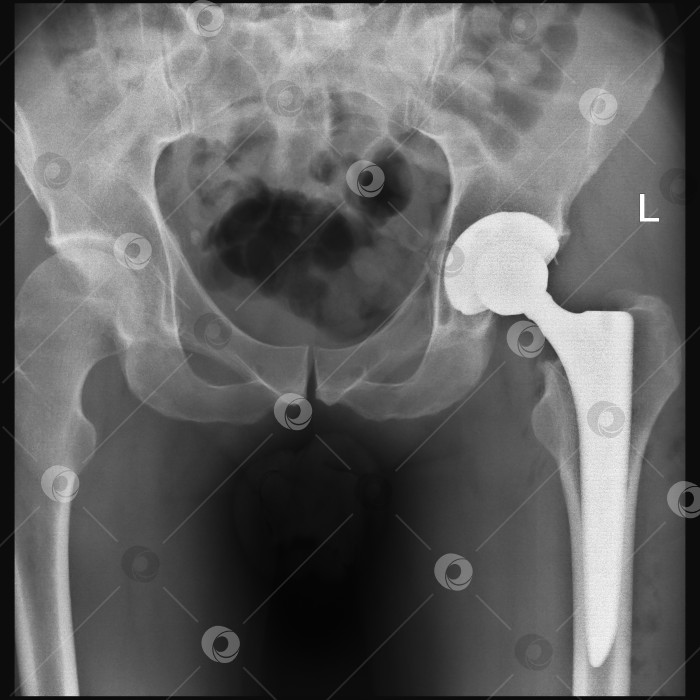 Скачать Рентгеновский снимок мужчины. На следующий день после тотального эндопротезирования тазобедренного сустава фотосток Ozero