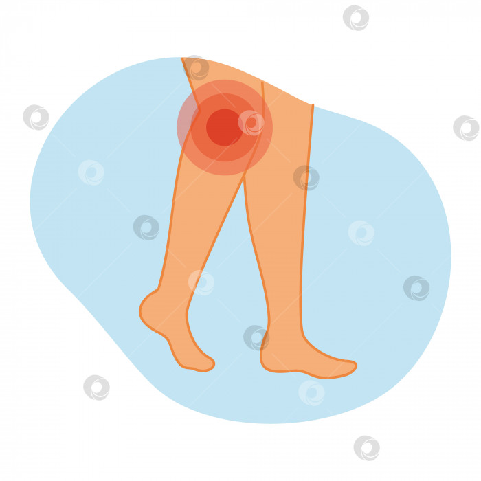 Скачать Артрит коленного сустава. Векторная иллюстрация ног с воспалением в области колена. Заболевания опорно-двигательного аппарата. фотосток Ozero
