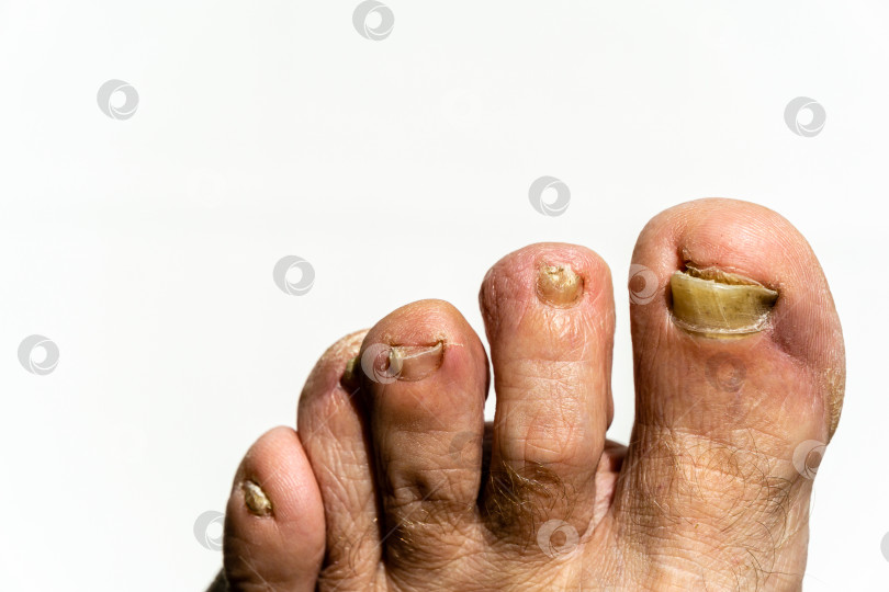 Скачать Грибок на ногтях ног. Ногти на ногах разрушены грибком. Грибок на ногтевой пластине. фотосток Ozero
