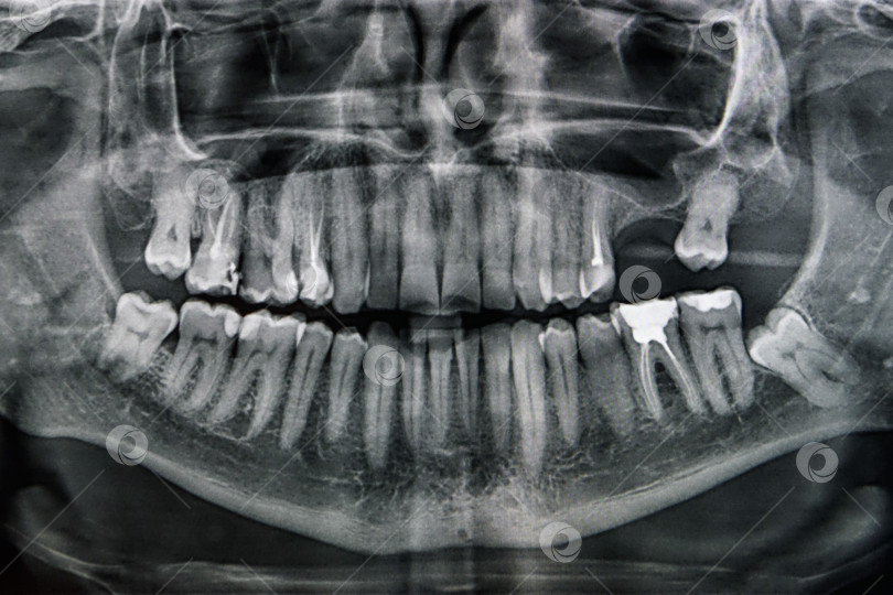 Скачать Рентгенограмма полости рта с зубами. Ортопантомограмма. фотосток Ozero
